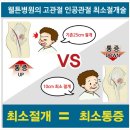 고관절통증//고관절수술로 "인공관절" 이미지