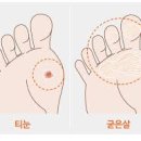 티눈으로 보험금 17억 타낸 여자 ㄷㄷ 이미지