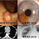 과오종 (Hamartoma) 종양 혈액질환 이란? 이미지