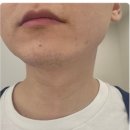 메티의원 | 남자 레이저제모 3회차 후기 진솔하게 (꼭 확인 하세요)