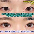 첫눈성형외과의원 네이버블로그