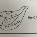 마리나산부인과의원 | 이천 마리나 산부인과 자궁경 수술 후기
