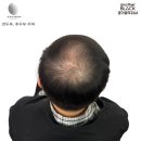여름철 땀에도 끄떡없는 두피커버의 비밀[경기광주두피문신]