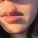 서울피부과의원 | 경주 피부과 서울s의원 후기 입술 헤르페스 낫는 과정