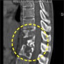 몸살에 극심한 허리 통증까지… &#39;척추결핵&#39; 의심해봐야 이미지