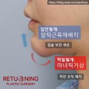 미사치유외과의원 | 앞턱근육재배치 후기 (입안절개 마녀턱수술) 이건 필독해야 합니다. by 성형외과전문의