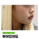 포인트성형외과의원 네이버블로그