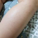 자연치유음식연구소 | 5개월 아기아토피 초기증상과 호전 사례 (자연치유 과정 사진 有)