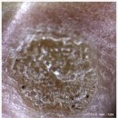 뿌리큰한의원 | 베루말 사마귀 제거 후기에서 뿌리까지 없애도 재발되는 이유