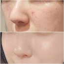 타이탄 짐 | 신사역 피부과 이브타이탄 중안부 리프팅 전후 효과 후기