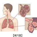 폐기종 효능 및 증상 원인 예방 이미지