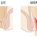 힐좌욕 네이버블로그