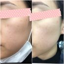 피에이치디피부과 색소후기