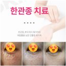 광주고운세상피부과의원 | 한관종 핀홀 시술 후기｜눈 밑 올록볼록, 2차 시술 후 딱지·붓기까지 기록!