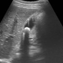 Adenomyomatosis with Gallstone (25/F) 이미지