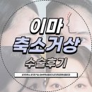 거상 | 이마축소 이마거상 3개월 후기, 2년 고민 끝에 받은 인생 수술