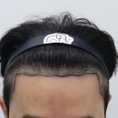 압구정맘모스헤어라인의원 이미지