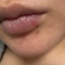 닥터윤마디의원 | 아랫입술에 몽우리 생겨서 방문한 논현동 닥터윤 뷰티플 피부과