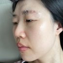 한산의원 | 부산 서면 피부과의원/내돈내산/11회차 시술 후기(~ing)/스타워커/젠틀맥스/제네시스/재생관리 시작!