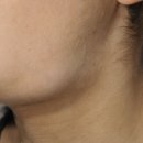 두   암 | 갑상선암 전이 증상 검사 치료 재발 후기