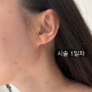 진정한의원 | 서면 편평사마귀제거, 재발 걱정 없는 피부한의원 후기