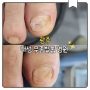 더블유(W)식자재마트 | 광주 내성 무좀발톱 병원 수완지구 실비보험으로 부담 줄인 치료 후기