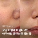 타임필의원 | 강남역 피부과 셀린의원 강남점 아쿠아필 블랙헤드 모공 이렇게까지 없어진다고?