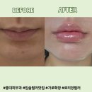 NO.1 자동차피부과 | [홍대피부과] 로리앙 입술필러 전후, 가로확장, 내돈내산 1주일 후기, 가격, 멍, 통증
