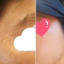 한독강남뷰티지점 | 강남 압구정 기미 잡티 제거, '미작뷰티 강남본점' 클리어스팟프로 2차 후기(시간,주차)