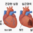 코로나19와 혈전(피떡):우리 몸에 남겨진 흔적들 혹시 아직도 머리가 멍하고 집중이 안 되시나요? 이미지