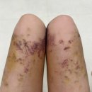 라온케어 | 천안지흡후관리 후기, 허벅지 멍·바본 케어는 천안 라온뷰티