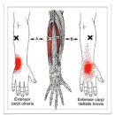 Extensor Carpi Radialis Longus (장요측 수근신근) 이미지