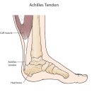 Achilles Tendon Injury 이미지