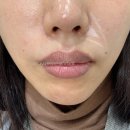 청담초등학교 | 내 일상 청담동피부과 팔자 쥬베룩볼륨 2회차 찐리얼후기