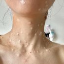 관심있는 사람에겐 큰 도움이 될 &#39;목&#39; 편평사마귀 제거 후기(제거 후 5개월째) 추후 경과