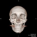 광대 잘 아시는 분~ ct사진 상세히 봐주시고, 고견 부탁드립니다. 이미지