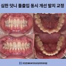 부천 중동 치과 심한 덧니 돌출입 동시 개선 발치 교정 사례