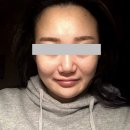 오아시스의원 | [시술] 압구정 루나의원 루비레이저 : 완전 깨끗해지는 피부 정찰제 가격으로 주근깨가 많을수록 이득...