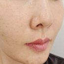 스킨풀 | 청담역피부과 청담루틴의원 스킨보톡스 풀페이스 손주사 후기 통증부터 피부 변화까지