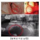 발육성 치성 낭종[Developmental odontogenic cysts]치과질환 이미지