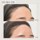 연세브이의원 | 영통 망포역 이마 필러, 이마 보톡스로 자연스럽고 세련된 이마라인 만들기! – 연세브이의원