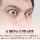 그레이브스병 검사 및 원인 안구돌출 이미지