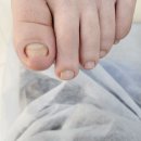 부평 내성발톱, 각질관리 문제성발은 여기! 레푸스부평CGV점