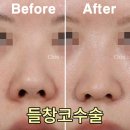 들창코 이미지