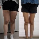 허벅지 지방흡입 4개월차 후기 붓기 다빠짐! 흉터 바본 식단관리 총정리