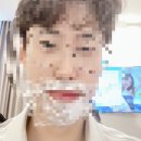 남자 수염 제모 후기