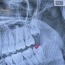오만용치과의원 | [인천/구월동] 서울이턱사랑니치과의원 :: 당일발치, 비용 보험 청구