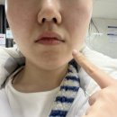 크로스리프팅 | 서면 온다리프팅 내돈내산 후기｜이중턱·팔자주름 리프팅 효과 솔직 리뷰