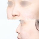 서진성형외과의원 | 예쁘고 귀엽고 다 하는 고민시 코 턱선, 나도 가능?
