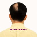 발산 남성 가발 후기, 정수리 커버한 리얼 변화 이야기